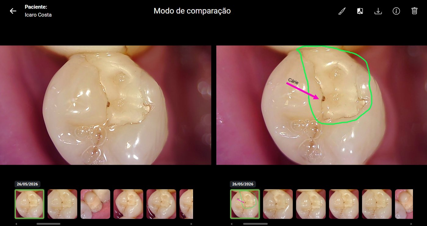 Comparação lado a lado de duas fotos intraorais do mesmo paciente no AWBook
