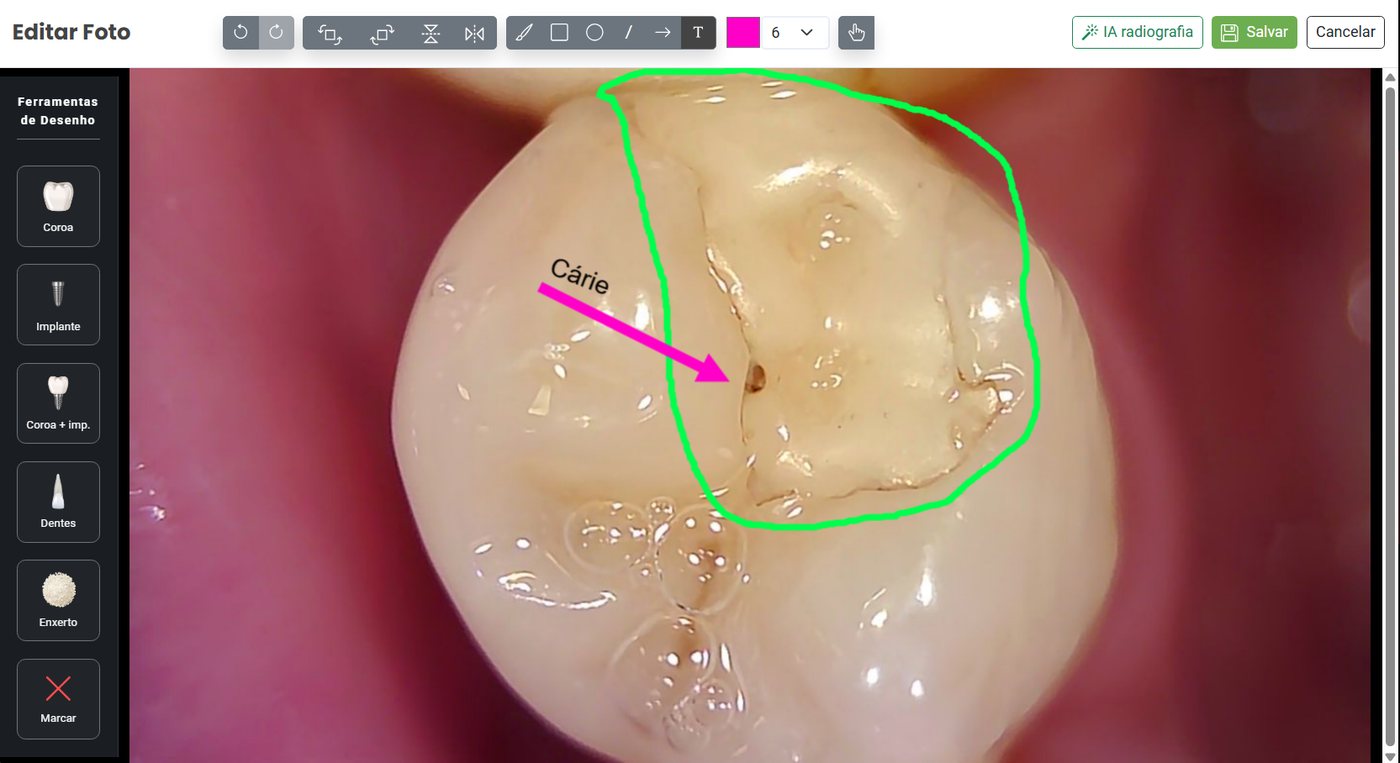 Editor do AWBook exibindo uma foto intraoral com marcações coloridas sobre o dente